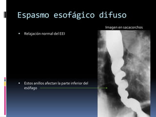 Espasmo esofágico difuso
 Relajación normal del EEI
 Estos anillos afectan la parte inferior del
esófago
Imagen en sacacorchos
 