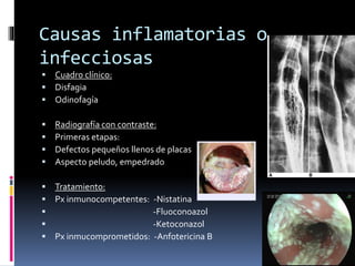 Causas inflamatorias o
infecciosas
 Cuadro clínico:
 Disfagia
 Odinofagía
 Radiografía con contraste:
 Primeras etapas:
 Defectos pequeños llenos de placas
 Aspecto peludo, empedrado
 Tratamiento:
 Px inmunocompetentes: -Nistatina
 -Fluoconoazol
 -Ketoconazol
 Px inmucomprometidos: -Anfotericina B
 