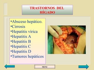 TRASTORNOS DEL
              HÍGADO

•Absceso hepático.
•Cirrosis
•Hepatitis vírica
•Hepatitis A
•Hepatitis B
•Hepatitis C
•Hepatitis D
•Tumores hepáticos

                 MENU
 