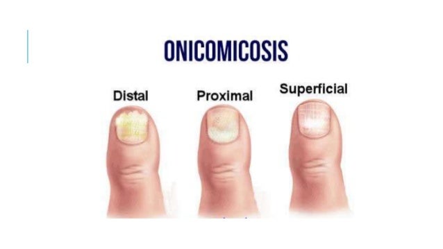 El champú para la piel seca de la psoriasis