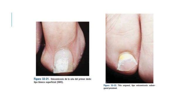 Como curar el hongo de las uñas de los pies por el vinagre