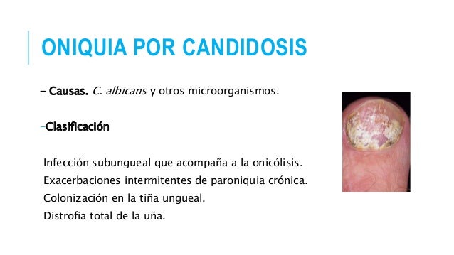 El hongo de las uñas en los pies donde dirigirse