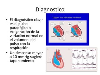 Diagnostico
• El diagnóstico clave
es el pulso
paradójico o
exageración de la
variación normal en
el volumen del
pulso con la
respiración.
• Un descenso mayor
a 10 mmHg sugiere
taponamiento
 