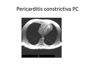 Pericarditis constrictiva PC
 