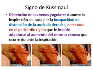 Signo de Kussmaul
• Distención de las venas yugulares durante la
inspiración causada por la incapacidad de
distención de la aurícula derecha, encerrada
en el pericardio rígido que le impide
adaptarse al aumento del retorno venoso que
ocurre durante la inspiración.
 