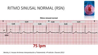 Normal Rsn Face Trastornos del ritmo auricular Platas ekg 2020 | PPTX