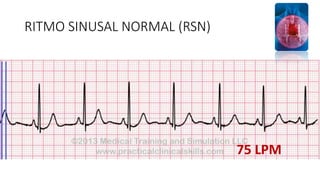 Normal Rsn Face Trastornos del ritmo auricular Platas ekg 2020 | PPTX