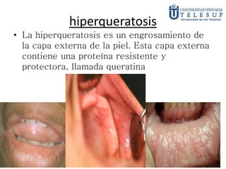 hiperqueratosis
• La hiperqueratosis es un engrosamiento de
la capa externa de la piel. Esta capa externa
contiene una proteína resistente y
protectora, llamada queratina
 