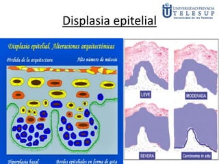 Displasia epitelial
 
