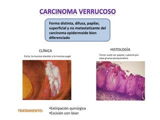Forma distinta, difusa, papilar,
superficial y no metastatizante del
carcinoma epidermoide bien
diferenciado
•Extirpación quirúrgica
•Escisión con láser
CLÍNICA HISTOLOGÍA
Encía, la mucosa alveolar y la mucosa yugal Tumor suele ser papilar, cubierta por
capa gruesa paraqueratina.
 