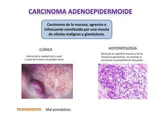 Carcinoma de la mucosa, agresivo e
infrecuente constituida por una mezcla
de células malignas y glandulares.
CLÍNICA HISTOPATOLOGÍA
Interior de la cavidad oral y nasal
( suelo de la boca y el paladar duro)
Deriva de la superficie mucosa y de los
conductos glandulares. Se asemeja al
carcinoma mucoepitelial de alto grado.
Mal pronóstico.
 