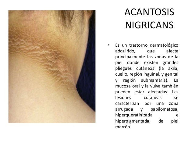 El lipoma sobre la persona la desaparición láser