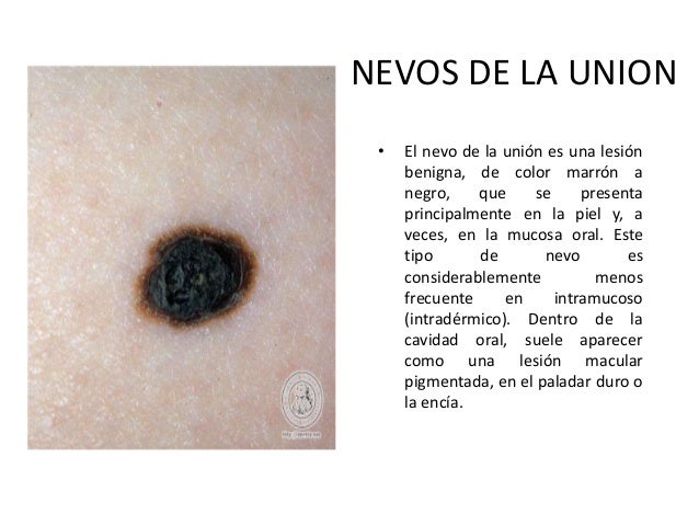 El aceite del árbol de té blanquea a la persona