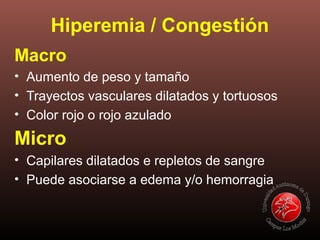 Macro
• Aumento de peso y tamaño
• Trayectos vasculares dilatados y tortuosos
• Color rojo o rojo azulado
Micro
• Capilares dilatados e repletos de sangre
• Puede asociarse a edema y/o hemorragia
Hiperemia / Congestión
 