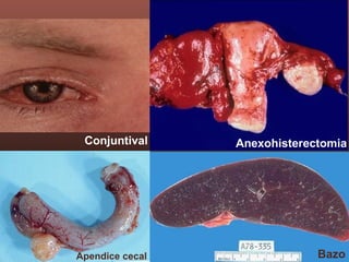 Conjuntival
Bazo
Anexohisterectomia
Apendice cecal
 