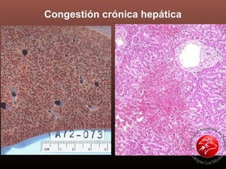 Congestión crónica hepática
 