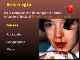 Hemorragia
Es la extravasacion de sangre del aparato
circulatorio hacia el Exterior, Interior o a un tejido
Causas
•Angiopatia
•Coagulopatía
•Mixta
 