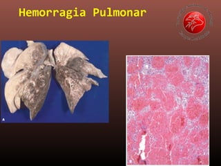 Hemorragia Pulmonar
 