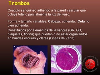 Trombos
Coagulo sanguineo adherido a la pared vascular que
ocluye total o parcialmente la luz del vaso.
Forma y tamaño variables. Cabeza: adherida; Cola no
bien adherida.
Constituidos por elementos de la sangre (GR, GB,
plaquetas, fibrina) que pueden o no estar organizados
en bandas oscuras y claras (Lineas de Zahn)
 