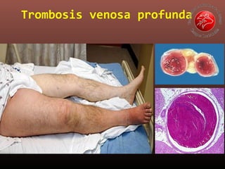 Trombosis venosa profunda

 