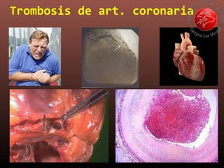 Trombosis de art. coronaria
 