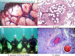 Tromboembolismo sistemico
E. septico
E. grasa
E. gaseosa. Enf de los buzos
 