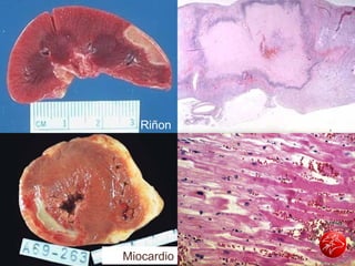 Infarto renal
Riñon
Miocardio
 