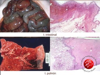 Infarto Hemorragico Intestino
I. intestinal
I. pulmón
 