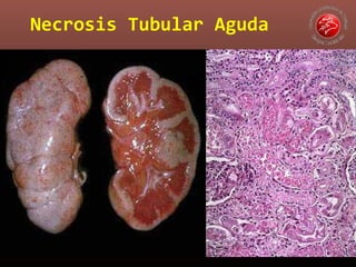Necrosis Tubular Aguda
 