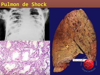 Pulmon de Shock
 