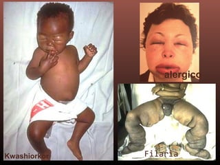 FilariaKwashiorkor
alergico
 