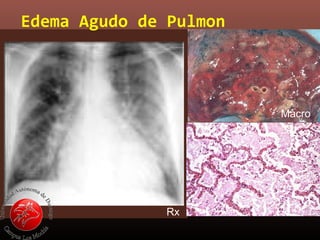 Edema Agudo de Pulmon
Rx
Macro
Micro
 