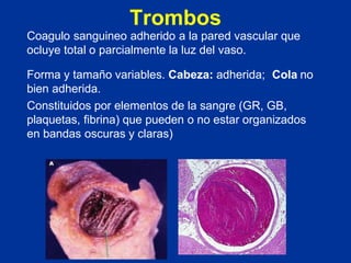 Trombos
Coagulo sanguineo adherido a la pared vascular que
ocluye total o parcialmente la luz del vaso.
Forma y tamaño variables. Cabeza: adherida; Cola no
bien adherida.
Constituidos por elementos de la sangre (GR, GB,
plaquetas, fibrina) que pueden o no estar organizados
en bandas oscuras y claras)
 