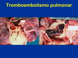 Tromboembolismo pulmonar

 