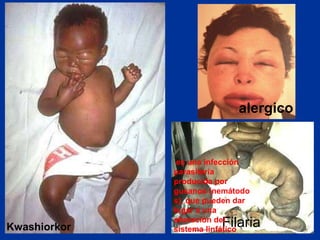 Filaria
Kwashiorkor
alergico
es una infección
parasitaria
producida por
gusanos (nemátodo
s), que pueden dar
lugar a una
alteración del
sistema linfático
 