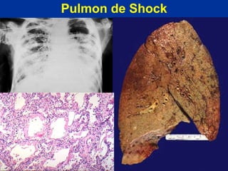 Pulmon de Shock 