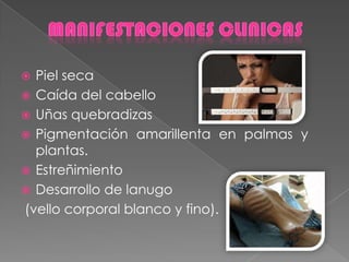  Piel seca
 Caída del cabello
 Uñas quebradizas
 Pigmentación amarillenta en palmas y
plantas.
 Estreñimiento
 Desarrollo de lanugo
(vello corporal blanco y fino).
 