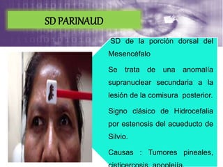 SD de la porción dorsal del
Mesencéfalo
Se trata de una anomalía
supranuclear secundaria a la
lesión de la comisura posterior.
Signo clásico de Hidrocefalia
por estenosis del acueducto de
Silvio.
Causas : Tumores pineales,
SD PARINAUD
 