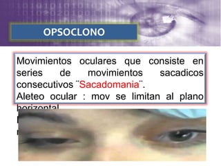 OPSOCLONO
Movimientos oculares que consiste en
series de movimientos sacadicos
consecutivos ¨Sacadomania¨.
Aleteo ocular : mov se limitan al plano
horizontal.
Encefalitis viral, traumatismo,
neuroblastoma, ca mamario.
 