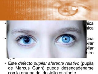 • La pupila de un ojo sin percepción lumínica
no responde a la estimulación lumínica
directa.
• Si sólo existe una lesión parcial de la retina
o del nervio óptico, la respuesta pupilar
directa será menor que la respuesta pupilar
consensual que se induce al iluminar el otro
ojo.
• Este defecto pupilar aferente relativo (pupila
de Marcus Gunn) puede desencadenarse
 