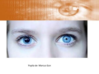 Pupila de Marcus Gun
 