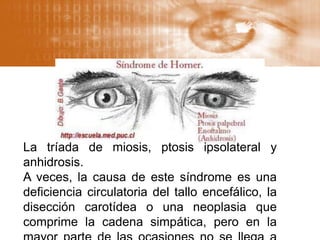 La tríada de miosis, ptosis ipsolateral y
anhidrosis.
A veces, la causa de este síndrome es una
deficiencia circulatoria del tallo encefálico, la
disección carotídea o una neoplasia que
comprime la cadena simpática, pero en la
 