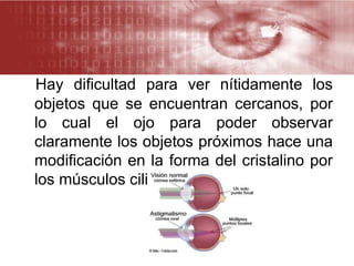 Hay dificultad para ver nítidamente los
objetos que se encuentran cercanos, por
lo cual el ojo para poder observar
claramente los objetos próximos hace una
modificación en la forma del cristalino por
los músculos ciliares
 