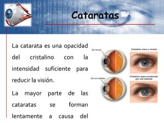 Cataratas
La catarata es una opacidad
del cristalino con la
intensidad suficiente para
reducir la visión.
La mayor parte de las
cataratas se forman
lentamente a causa del
 