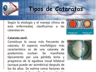Tipos de Cataratas
Según la etiología y el manejo clínico de
esta enfermedad, clasificamos a las
cataratas en:
Catarata senil.
Constituye la causa más frecuente de
catarata. El aspecto morfológico más
característico es de una catarata de
predominio nuclear. Se manifiesta
típicamente por una pérdida lenta y
progresiva de la agudeza visual bilateral
(aunque puede ser asimétrica) después de
los 60 años. Se estima como factores de
 