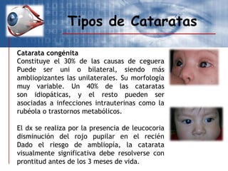 Tipos de Cataratas
Catarata congénita
Constituye el 30% de las causas de ceguera
Puede ser uni o bilateral, siendo más
ambliopizantes las unilaterales. Su morfología
muy variable. Un 40% de las cataratas
son idiopáticas, y el resto pueden ser
asociadas a infecciones intrauterinas como la
rubéola o trastornos metabólicos.
El dx se realiza por la presencia de leucocoria
disminución del rojo pupilar en el recién
Dado el riesgo de ambliopía, la catarata
visualmente significativa debe resolverse con
prontitud antes de los 3 meses de vida.
 