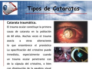 Tipos de Cataratas
Catarata traumática.
El trauma ocular constituye la primera
causa de catarata en la población
de 60 años. Muchas veces el trauma
asocia a otras alteraciones
lo que ensombrece el pronóstico
La opacificación del cristalino puede
inmediata, especialmente cuando
un trauma ocular penetrante con
de la cápsula del cristalino, o bien
 