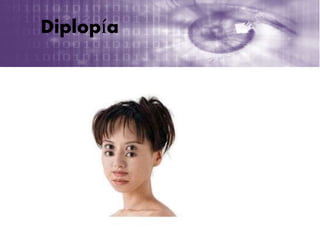 Diplopía
 