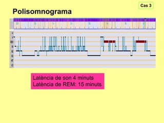 Cas 3

Polisomnograma

Latència de son 4 minuts
Latència de REM: 15 minuts

 