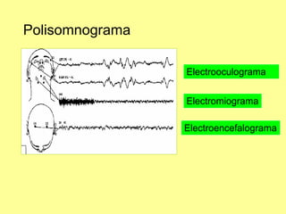 Polisomnograma
Electrooculograma
Electromiograma
Electroencefalograma

 